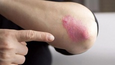 Dùng thảo dược tăng miễn dịch - hướng tiếp cận bền vững khi bị vảy nến