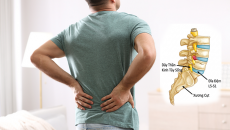 Triệu chứng cảnh báo thoát vị đĩa đệm lưng không nên bỏ qua