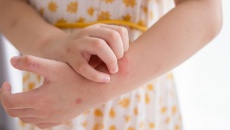 Giải pháp thảo dược cho trẻ bị nổi mề đay