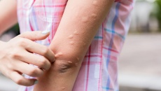 Nổi mề đay mùa Hè, phải làm sao?