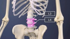 Dấu hiệu nhận biết thoát vị đĩa đệm L3 L4