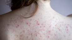 Bị mụn lưng phải làm sao?