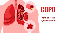 Cách nhận biết sớm bệnh phổi tắc nghẽn mạn tính (COPD)