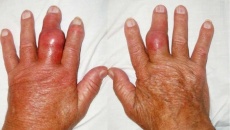 Hạt tophi xuất hiện ở người bệnh gout: Cảnh báo không nên chủ quan