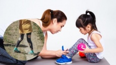 Khớp gối vẹo ngoài: Dáng đi bất thường ở trẻ cha mẹ nên theo dõi