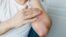 Nguyên nhân nào khiến vảy nến lan ra toàn thân?