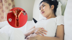 Đột phá điều trị lạc nội mạc tử cung bằng sóng cao tần