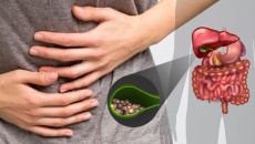 Sỏi mật gây đau bụng, đầy trướng và chậm tiêu xử trí thế nào?