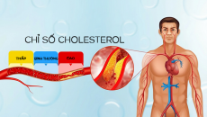 Tăng cholesterol kéo dài: Mối nguy âm thầm thúc đẩy xơ vữa động mạch