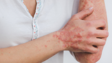 Những hiểu lầm khiến người bệnh vảy nến thêm tự ti