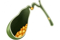 Sỏi cổ túi mật 10mm có nguy hiểm không?