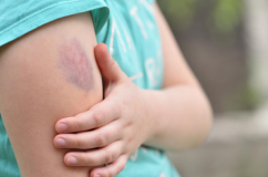 6 dấu hiệu cảnh báo nhiễm trùng máu 