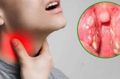 Khi bị viêm họng nên kiêng ăn gì?