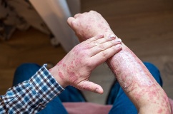 Vảy nến toàn thân khó chữa ra sao?