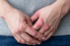 Giải pháp cho người vảy nến đang điều trị bệnh dạ dày