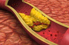 5 cách cải thiện mỡ máu cao hiệu quả