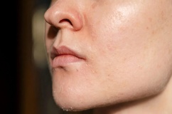 Cần làm gì khi da mặt bị bong tróc vào trời lạnh?