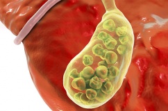 Có đám sỏi mật 27mm phải làm sao?