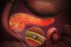 Có sỏi ống tụy 12mm cần xử trí thế nào để kiểm soát bệnh?