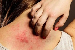 Vì sao bệnh vảy nến trở nặng khi trời lạnh?