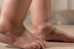 Sưng tấy bàn chân kéo dài cảnh báo dấu hiệu bệnh lý gì?