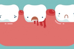 Cách cải thiện tình trạng chảy máu chân răng