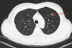 Đi khám sỏi thận, phát hiện ung thư phổi giai đoạn sớm nhờ AI
