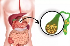 Sỏi túi mật 7,5mm có nguy hiểm không?