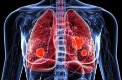 Những dấu hiệu cảnh báo u phổi ác tính không nên bỏ qua