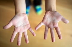 Cha mẹ cần cảnh giác với bệnh tay chân miệng ở trẻ