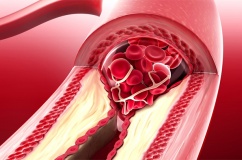 Hẹp mạch vành do vôi hóa khác gì do mảng bám cholesterol?