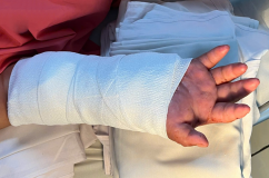 Nối lại bàn tay đứt lìa cho sản phụ, sau 2 tháng được 'ghép tạm' vào chân