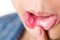 Dấu hiệu ở miệng chứng tỏ bạn thiếu vitamin B12