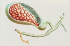 Sỏi mật 8,9mm và 15mm chưa có biến chứng có nguy hiểm không?