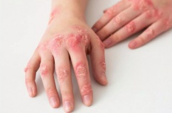 Người bệnh lupus ban đỏ nên ăn gì để kiểm soát triệu chứng tốt?