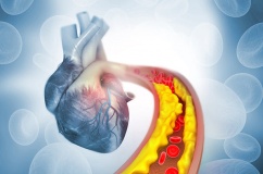 Tăng huyết áp kèm cholesterol cao: “Bộ đôi” đẩy nhanh xơ vữa mạch