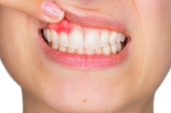 “Thủ phạm” gây viêm lợi và cách phòng ngừa thế nào?