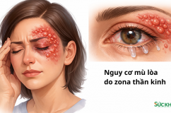 Nguy cơ mù lòa do zona thần kinh
