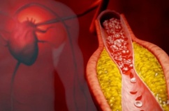 Xơ vữa động mạch - “Kẻ giết người thầm lặng” và giải pháp phòng ngừa hiệu quả