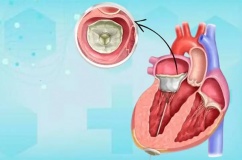 Bệnh hở van tim và tim to có chữa khỏi được không?