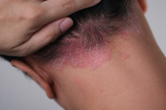 Vảy nến da đầu dễ tái phát, cải thiện ra sao?