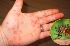 Sốt xuất huyết, tay chân miệng nặng tăng cao, Bộ Y tế cảnh báo khẩn