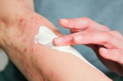 Dấu hiệu thường gặp của bệnh zona