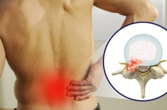 Thói quen hàng ngày khiến bệnh thoát vị đĩa đệm nặng hơn