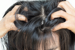 5 yếu tố âm thầm khiến vảy nến da đầu tái phát liên tục