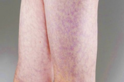 Dấu hiệu lạ trên da có thể cảnh báo vấn đề tim mạch