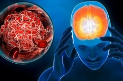 Nguyên nhân tai biến mạch máu não và cách phòng ngừa hiệu quả