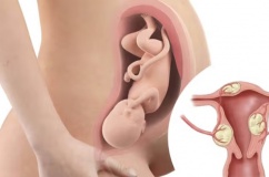 U xơ tử cung có gây khó mang thai không?