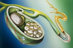 Tại sao đã mổ lấy sỏi mật 13mm vẫn tái phát sau 6 tháng?