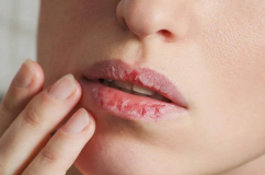 Giải pháp cải thiện tình trạng môi khô, nứt nẻ